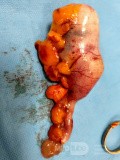 Laparoskopische Entfernung von Appendix-Neoplasmen