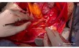 Thorakoabdominales Aortenaneurysma und Ersatz durch verzweigtes tubuläres Transplantat