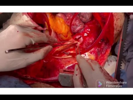 Thorakoabdominales Aortenaneurysma und Ersatz durch verzweigtes tubuläres Transplantat