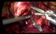 Kontrolle der Blutung aus der  obere Mesenterialvene