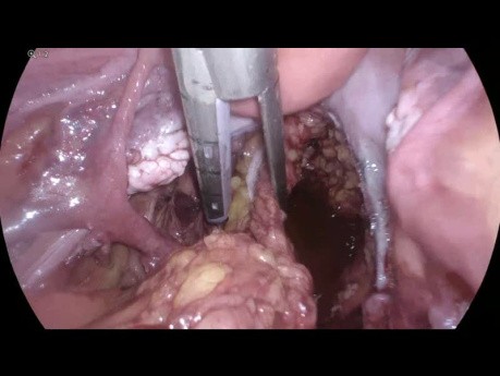 Laparoskopische anteriore Resektion von einem Darmkrebs