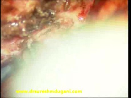 Riechfurchen-Meningeom – mikrochirurgische Exzision