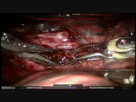 S3 - anatomische Segmentektomie, roboterassistierte Chirurgie