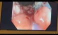 Endoskopische Mukosaresektion (EMR) des Dickdarmpolypen