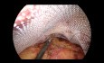 Nähfertigkeiten in TAPP für die laparoskopische Leistenhernienreparatur