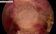 Uterus septus- eine Störung in der Embryonalentwicklung