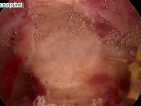 Uterus septus- eine Störung in der Embryonalentwicklung