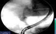 Überwindung der „unpassierbaren“ hilären Angulation beim ERCP-Stenting