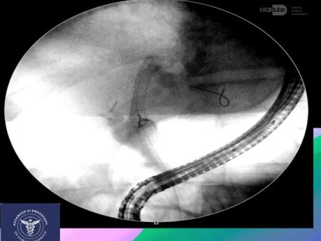 Überwindung der „unpassierbaren“ hilären Angulation beim ERCP-Stenting