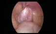 Bilaterale laparoskopische Orchiopexie