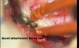 Rückenmarkstumor – Intradurales Meningeom – Mikrochirurgie