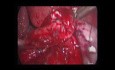Blasenendometriose