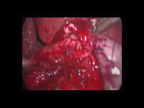 Blasenendometriose