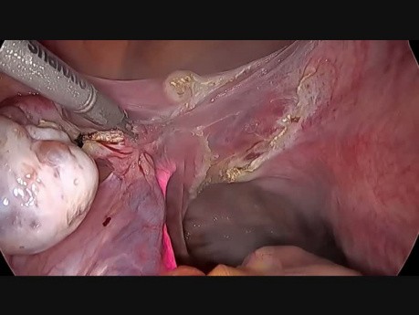 Totale laparoskopische Hysterektomie (Nellore)