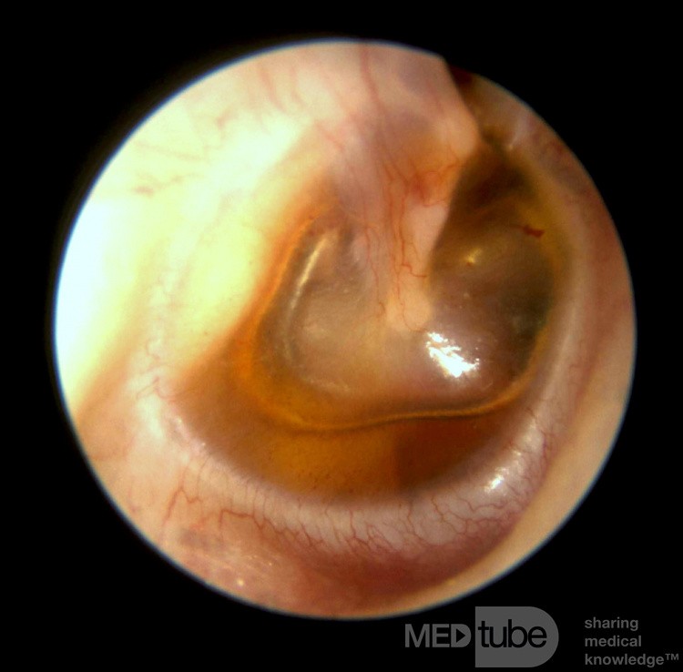 Seröse Otitis media - Luft-Flüssigkeitsspiegel