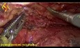 Thorako-Laparoskopische Ösophagektomie – Thorax Teil 4