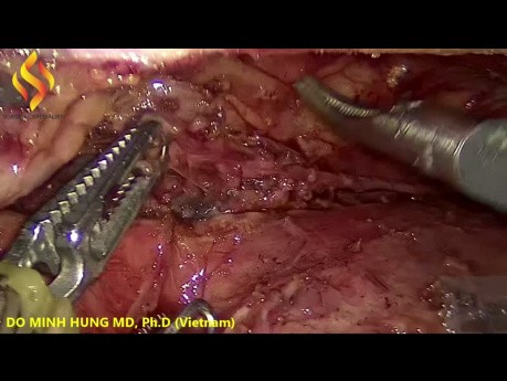 Thorako-Laparoskopische Ösophagektomie – Thorax Teil 4