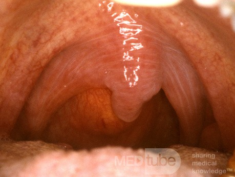 Retropharyngealabszess
