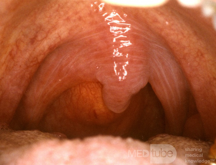 Retropharyngealabszess