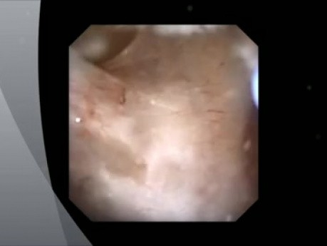 RIRS - Dilatation einer rezidivierenden Ureterstenose