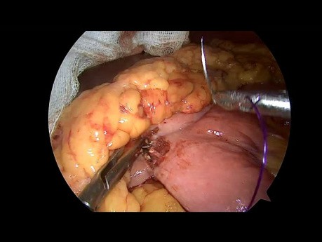 Laparoskopische gastrointestinale Anastomose mit Enterostomie