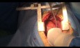 Simultane Herz- und Nierentransplantation