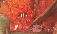 Vorhofresektion bei nicht-kleinzelligem T4-Lungenkrebs mit Beteiligung des linken Vorhofs