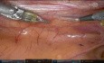Robotische Entnahme der Arteria mammaria interna (IMA)
