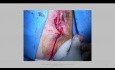 Granulosazelltumor der Vulva - Exzision und Insellappen