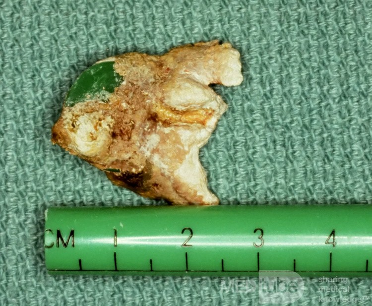 Chirurgisches Rhinolith-Exemplar