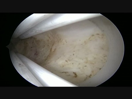 Hysteroresektoskopie - Uterusmyom