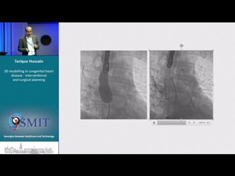 3D-Modellierung bei angeborenen Herzfehlern – Interventionelle und chirurgische Planung