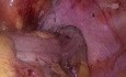 Laparoskopische Sigmoidresektion mit Lebermetastasektomie