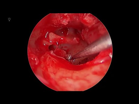 Endoskopische Typ 3 PORP Tympanoplastik 3