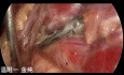 Dual-Port Trans-Subclavian Schilddrüsen-Endoskopiechirurgie (Teil 5)
