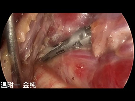 Dual-Port Trans-Subclavian Schilddrüsen-Endoskopiechirurgie (Teil 5)