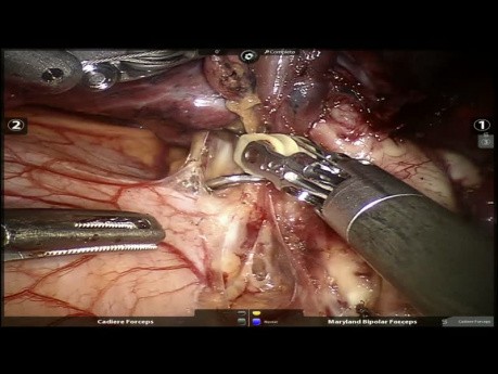 Lungenkarzinom - VAMLA und roboterassistierte Lobektomie Oberlappen links