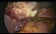 Totale laparoskopische Hysterektomie mit Eierstöcken bei einem Patienten nach Kaiserschnitt