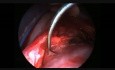 Endoskopische parapharyngeale Tumorentfernung