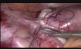 Laparoskopische Myomektomie- intraligamentäres Myom im Ligamentum latum uteri