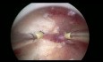 Uterus septus