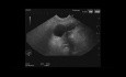 Endoskopischer Ultraschall für Bauchspeicheldrüse-IPMN