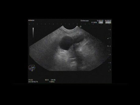 Endoskopischer Ultraschall für Bauchspeicheldrüse-IPMN