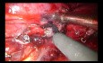 Uniportal-VATS-Sleeve-Lobektomie 