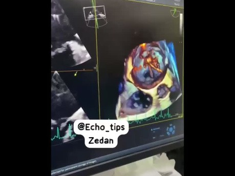 3D-transösophageale Echokardiographie bei der perkutanen Ballon-Mitralklappenplastik