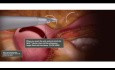 Laparoskopische Myomektomie, 3-Schichten-Verschluss Animation mit bidirektionaler Quill®-Widerhakennaht