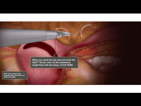 Laparoskopische Myomektomie, 3-Schichten-Verschluss Animation mit bidirektionaler Quill®-Widerhakennaht