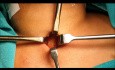Tracheotomie-Technik