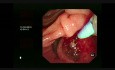 ERCP für Choledocholithiasis
