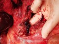 Viszeralvenenthrombose